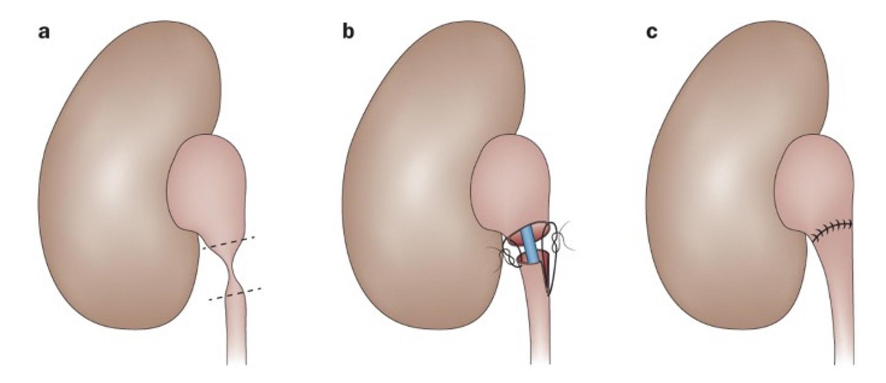 Ureteropelvic Junction Obstruction